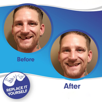 Veneers For Upper And Lower Teeth — Instant Smile Removable Set