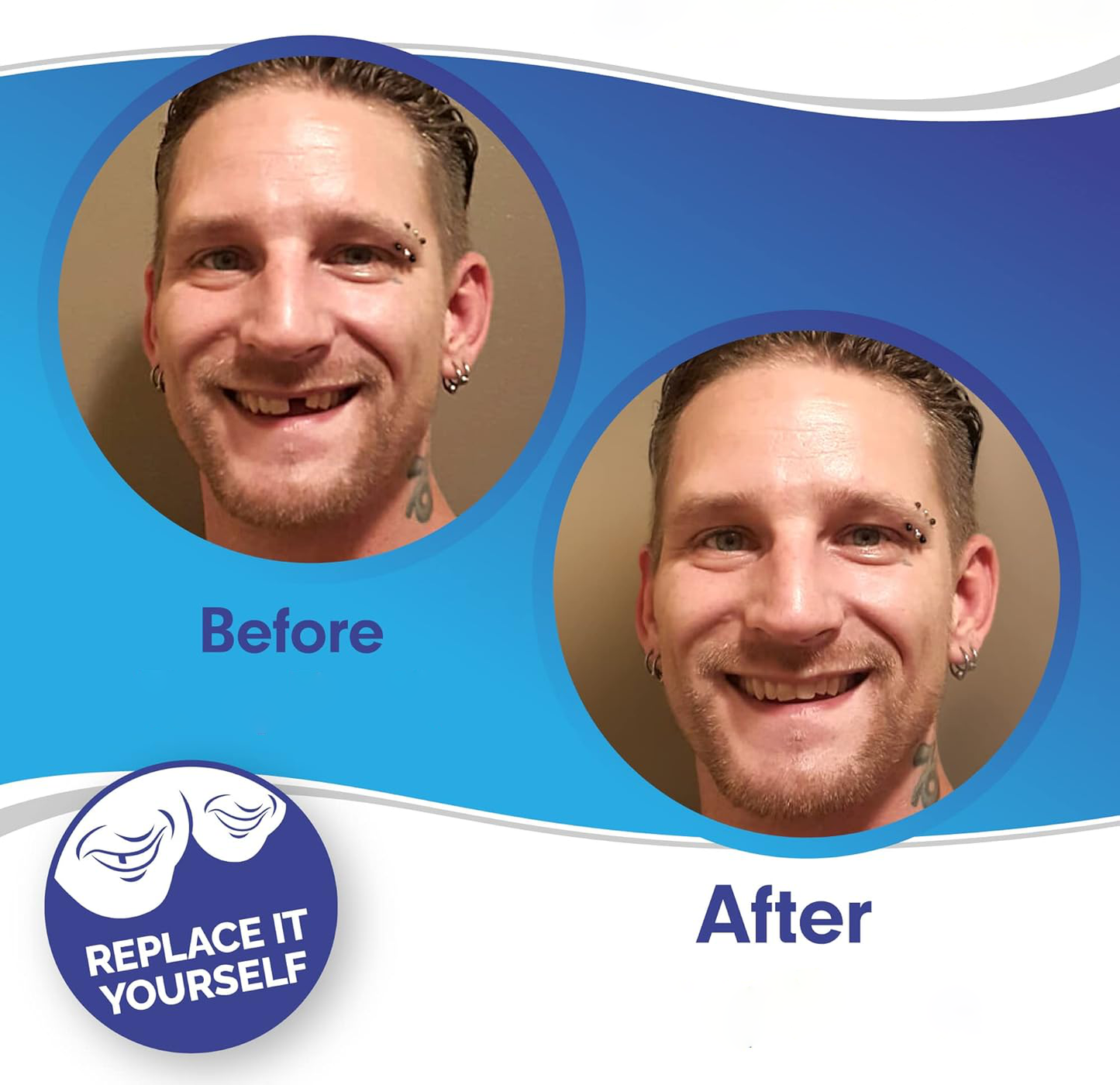 Veneers For Upper And Lower Teeth — Instant Smile Removable Set