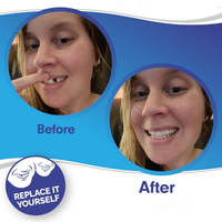 Veneers For Upper And Lower Teeth — Instant Smile Removable Set