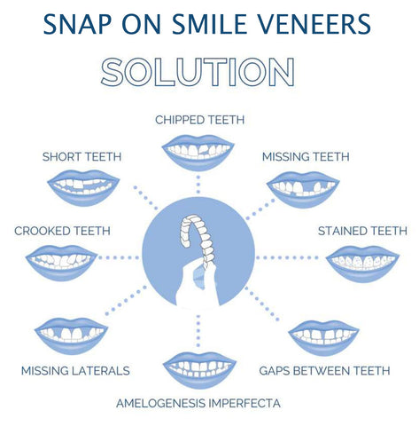 Veneers For Upper And Lower Teeth — Instant Smile Removable Set