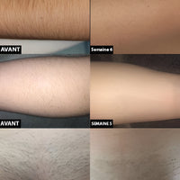 Laser Hair Removal For Long Term Hair Reduction And Smooth Skin