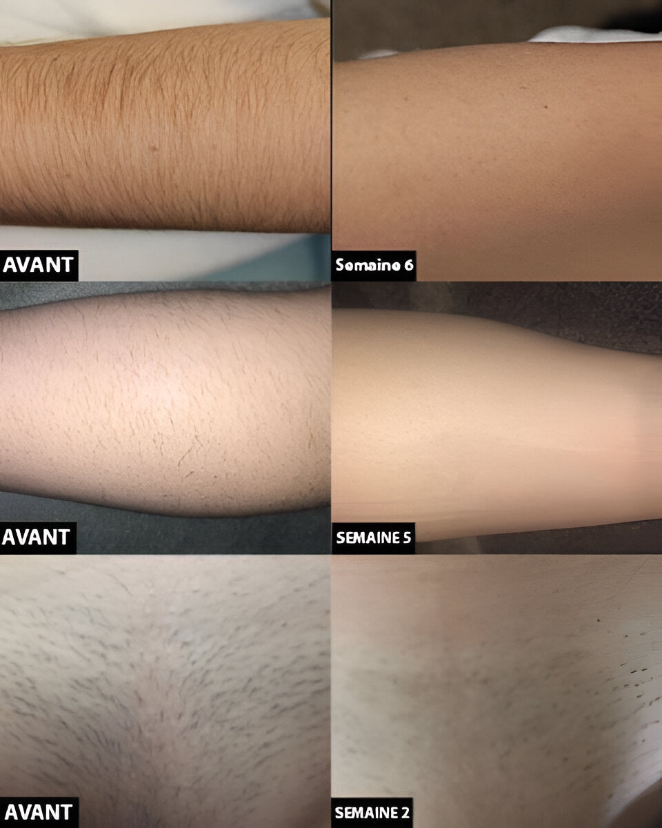 Laser Hair Removal For Long Term Hair Reduction And Smooth Skin